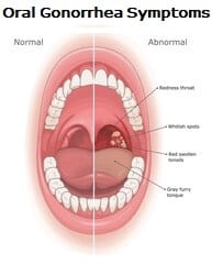 gonorrhea oral symptoms